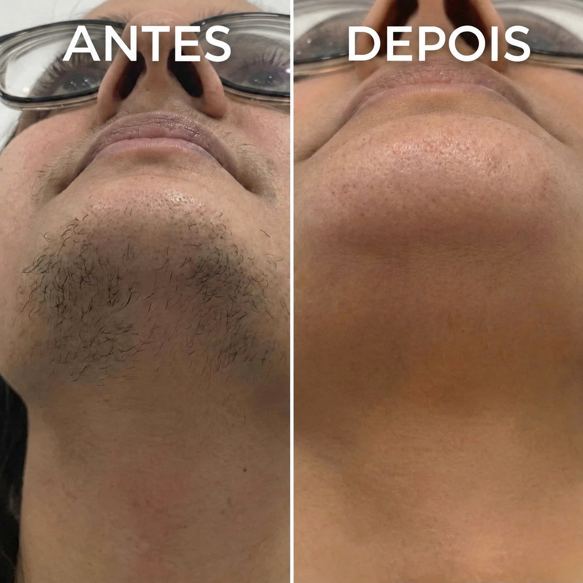 Inibidor vegetal de pelos