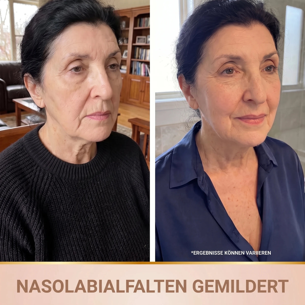 Vorher-Nachher: Nasolabialfalten gemildert