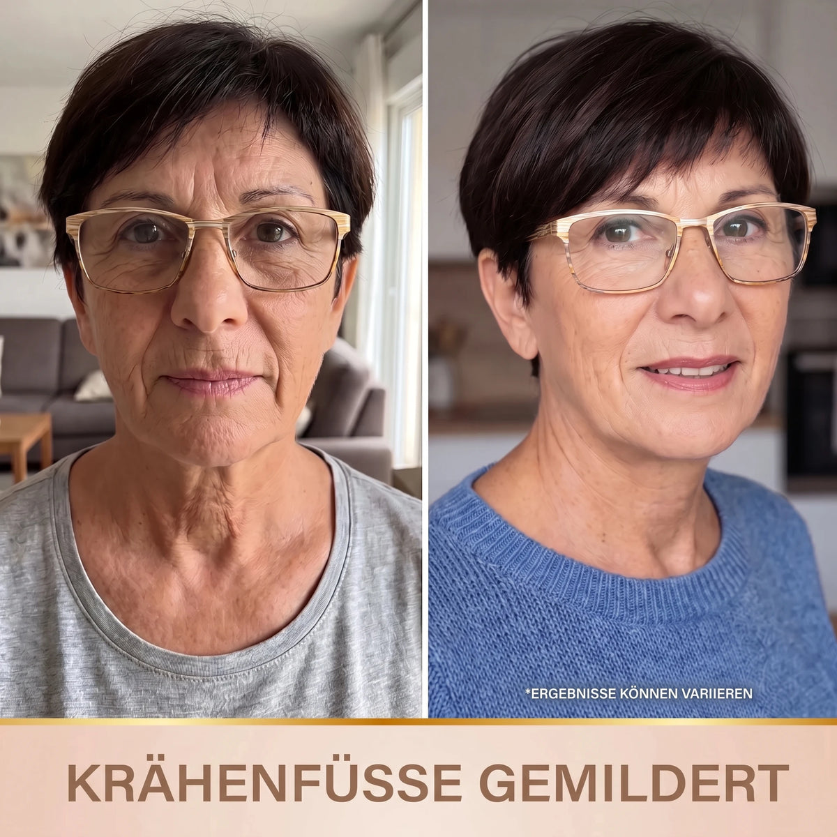 Vorher-Nachher: Krähenfüße gemildert